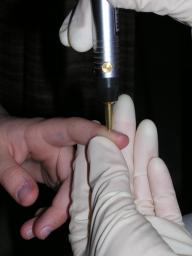 Foto einer Elektroakupunkturbehandlung durch Heilpraktikerin mit einem Stift am Zeigefinger